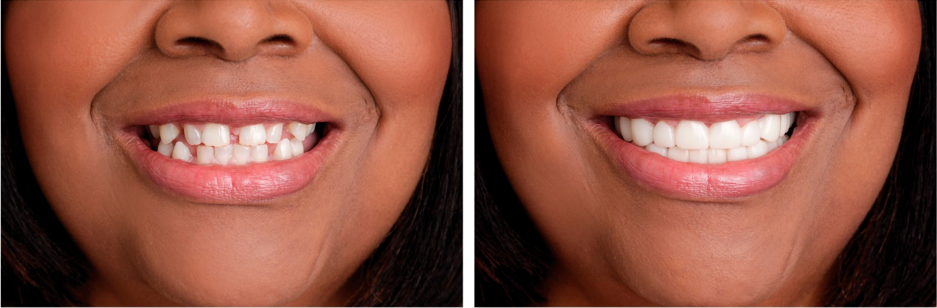 Antes y Después Caso 1