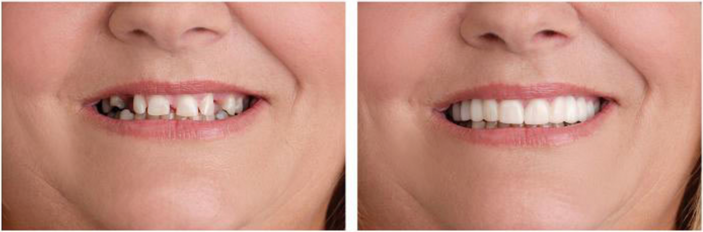 Antes y Después Caso 3