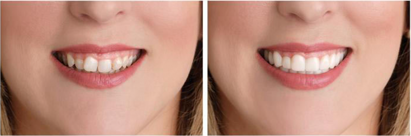 Antes y Después Caso 4